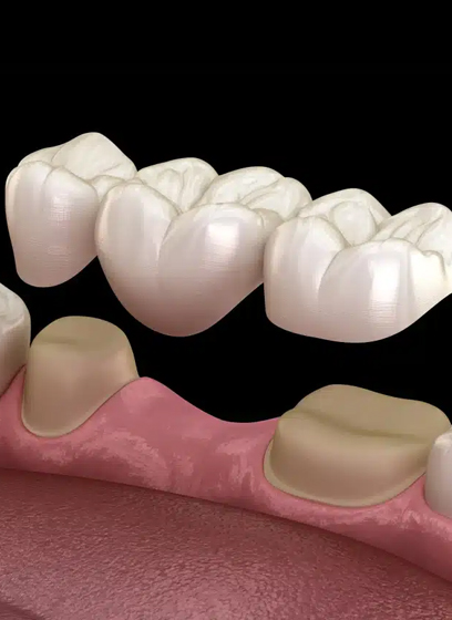 Dental Bridges Fort Myers, FL