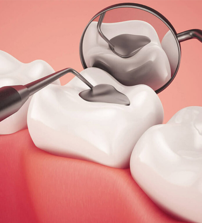 Dental Fillings In Fort Myers