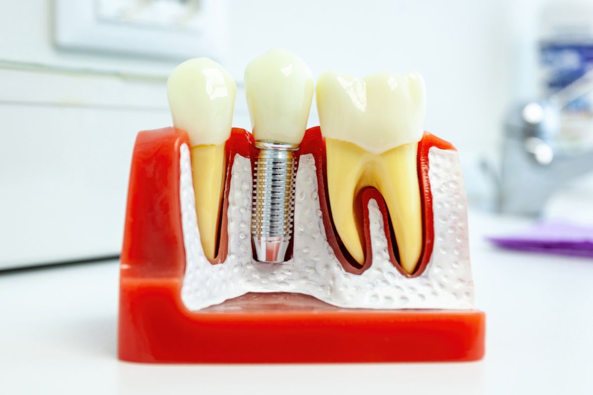 dental implants in fort myers