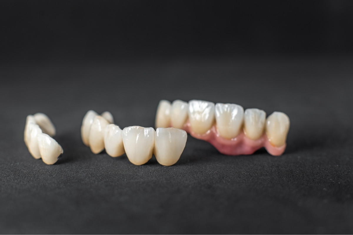 Dental Crowns