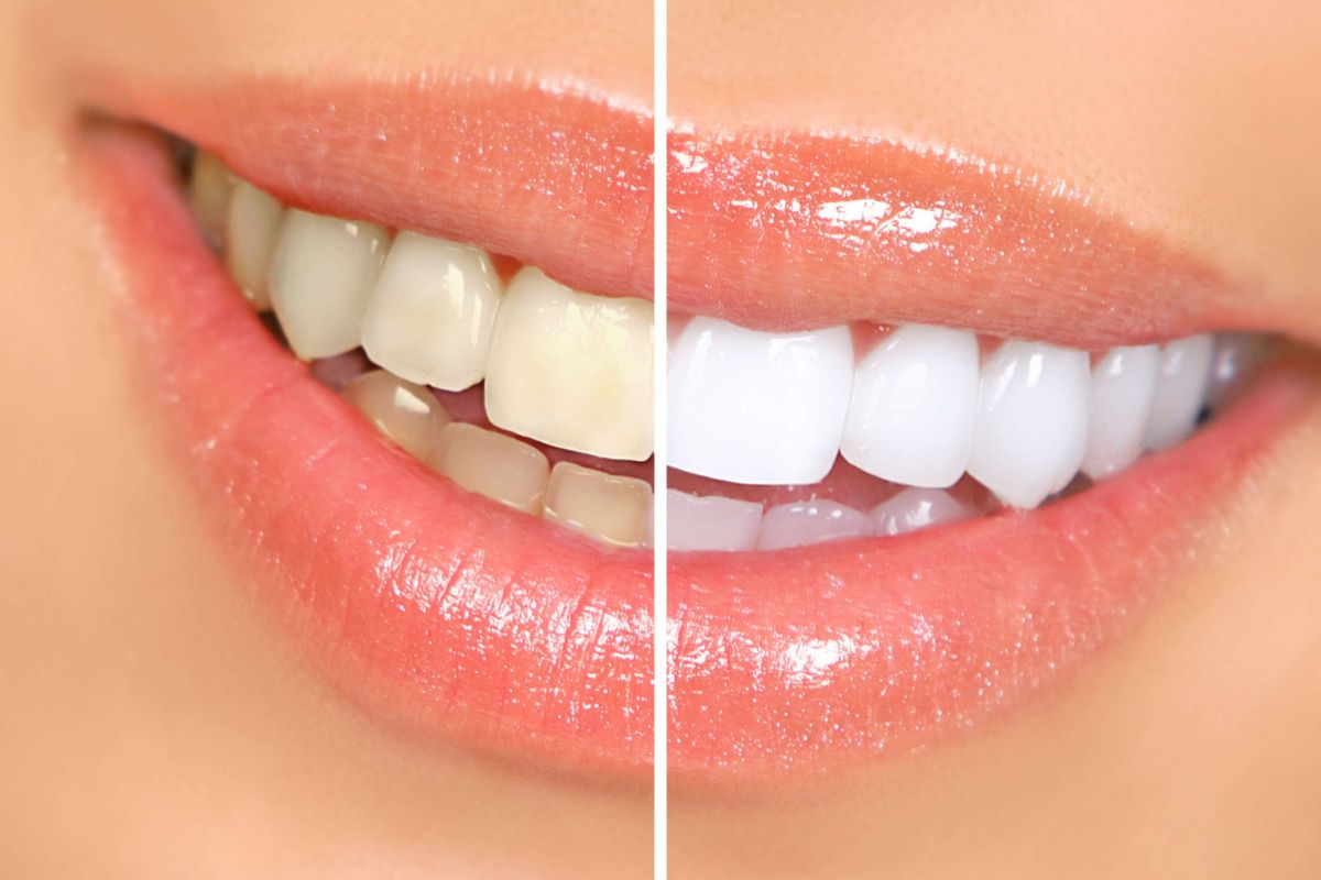 can-cosmetic-dentistry-brighten-gray-teeth-in-fort-myers
